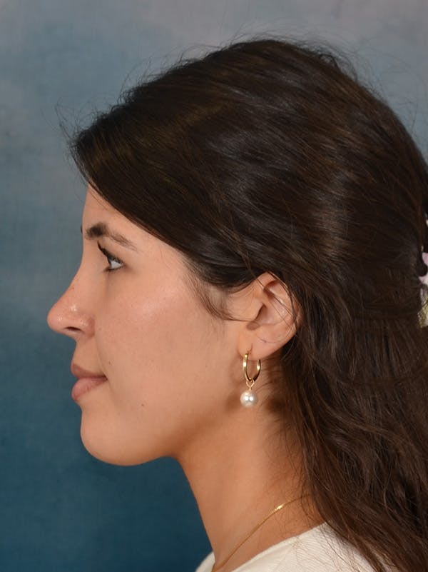 Rhinoplasty Before & After Gallery - Patient 409507 - Image 2