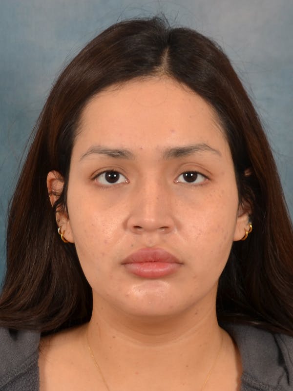 Rhinoplasty Before & After Gallery - Patient 280994 - Image 5