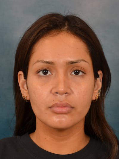 Rhinoplasty Before & After Gallery - Patient 280994 - Image 6