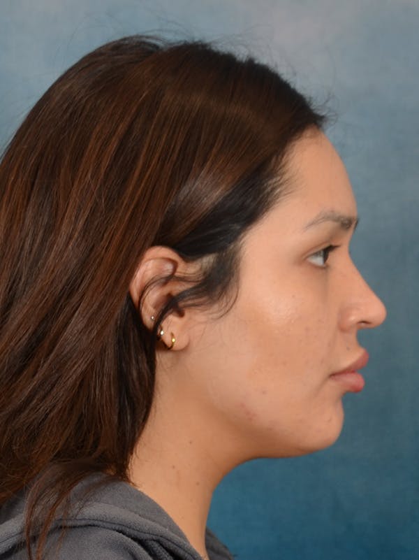 Rhinoplasty Before & After Gallery - Patient 280994 - Image 9