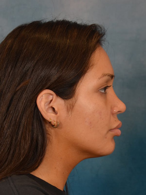 Rhinoplasty Before & After Gallery - Patient 280994 - Image 10