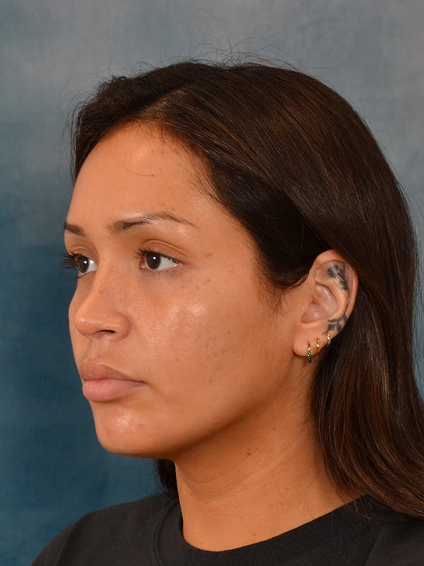 Rhinoplasty Before & After Gallery - Patient 280994 - Image 4