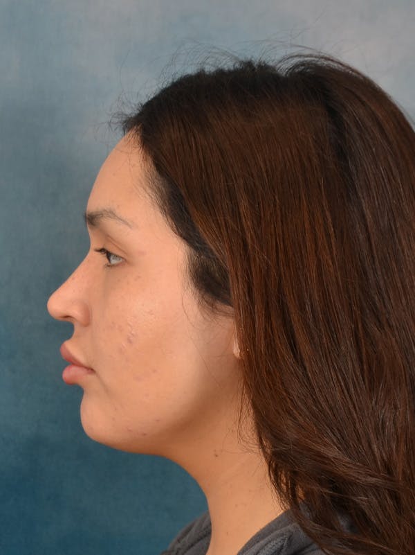 Rhinoplasty Before & After Gallery - Patient 280994 - Image 1