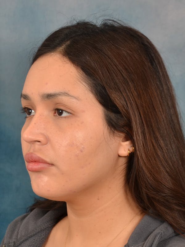 Rhinoplasty Before & After Gallery - Patient 280994 - Image 3