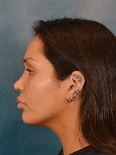 Rhinoplasty Before & After Gallery - Patient 544468 - Image 2