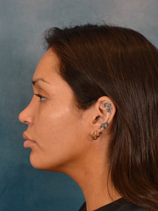 Rhinoplasty Before & After Gallery - Patient 280994 - Image 2