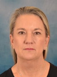 Fat Transfer Before & After Gallery - Patient 300180 - Image 1