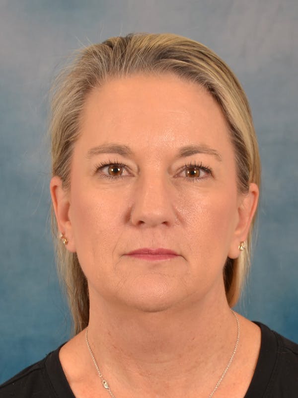 Deep Plane Facelift Before & After Gallery - Patient 106364 - Image 5