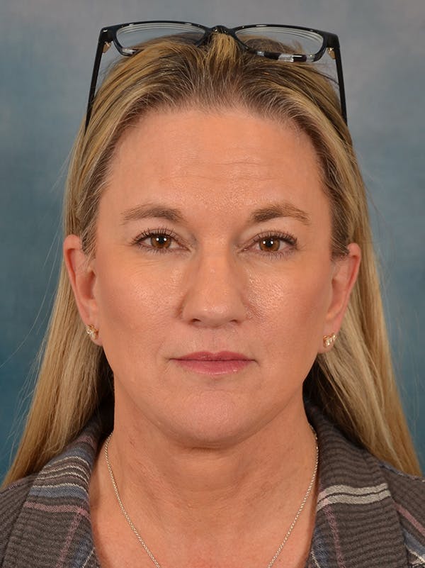 Deep Plane Facelift Before & After Gallery - Patient 106364 - Image 6