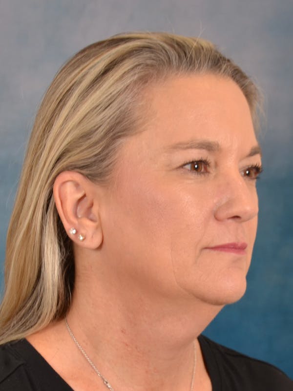 Deep Plane Facelift Before & After Gallery - Patient 106364 - Image 7