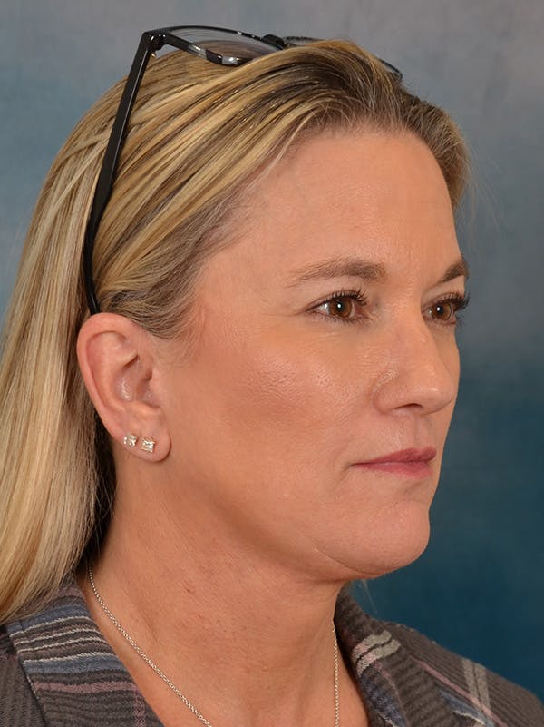 Deep Plane Facelift Before & After Gallery - Patient 106364 - Image 8