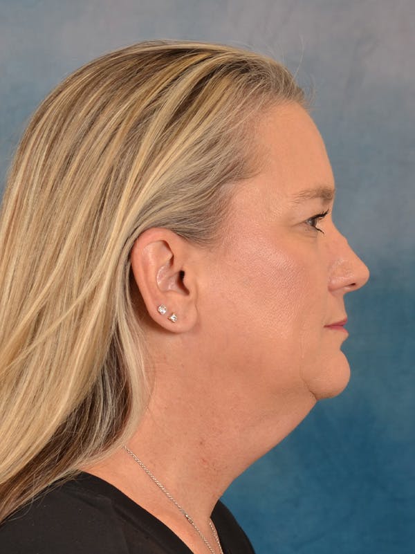 Deep Plane Facelift Before & After Gallery - Patient 106364 - Image 9