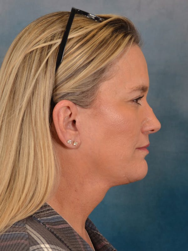 Deep Plane Facelift Before & After Gallery - Patient 106364 - Image 10