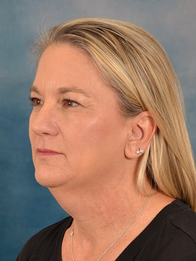 Deep Plane Facelift Before & After Gallery - Patient 106364 - Image 1