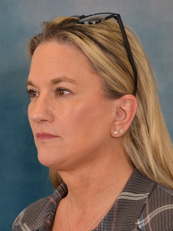 Deep Plane Facelift Before & After Gallery - Patient 106364 - Image 2