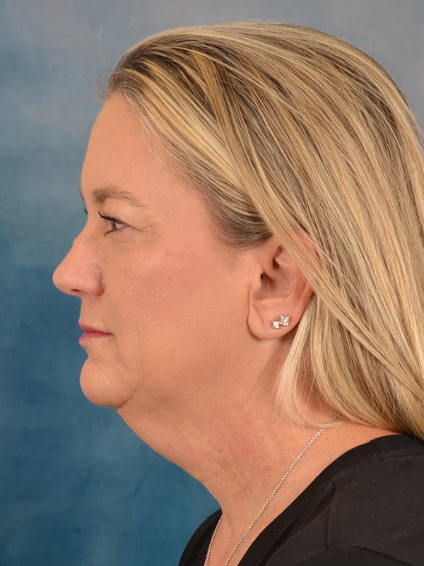 Deep Plane Facelift Before & After Gallery - Patient 106364 - Image 3