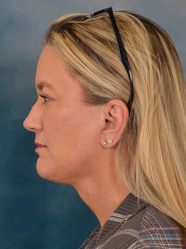 Deep Plane Facelift Before & After Gallery - Patient 106364 - Image 4