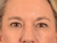 Eyelid Lift Before & After Gallery - Patient 335397 - Image 1