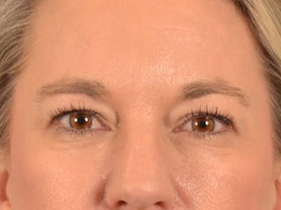 Eyelid Lift Before & After Gallery - Patient 335397 - Image 1