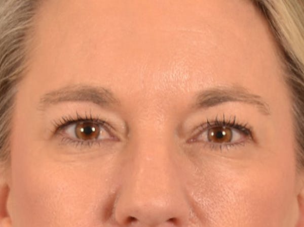 Eyelid Lift Before & After Gallery - Patient 335397 - Image 1