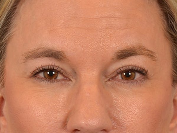 Eyelid Lift Before & After Gallery - Patient 335397 - Image 2