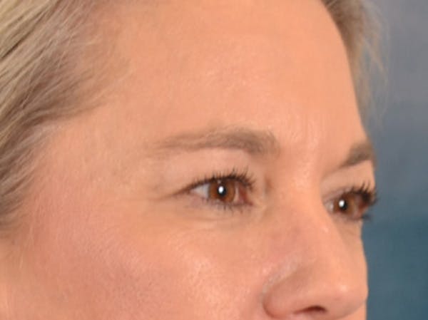 Eyelid Lift Before & After Gallery - Patient 335397 - Image 3