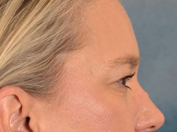 Eyelid Lift Before & After Gallery - Patient 335397 - Image 5