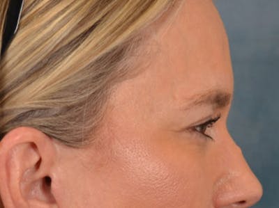 Eyelid Lift Before & After Gallery - Patient 335397 - Image 6