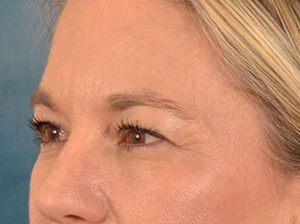 Eyelid Lift Before & After Gallery - Patient 335397 - Image 7