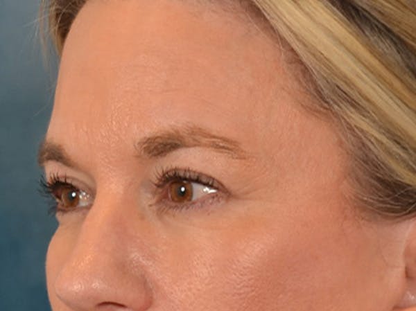Eyelid Lift Before & After Gallery - Patient 335397 - Image 8