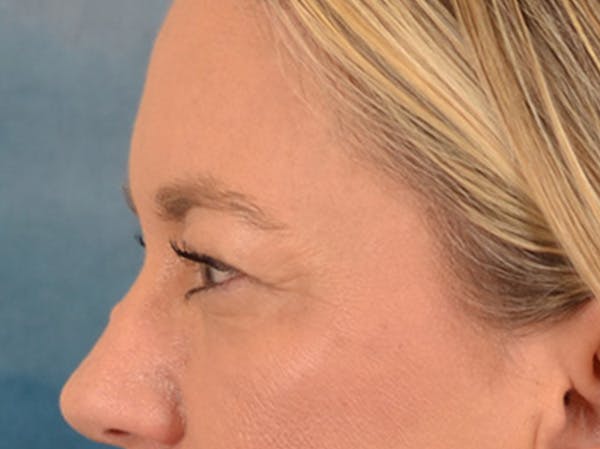 Eyelid Lift Before & After Gallery - Patient 335397 - Image 9