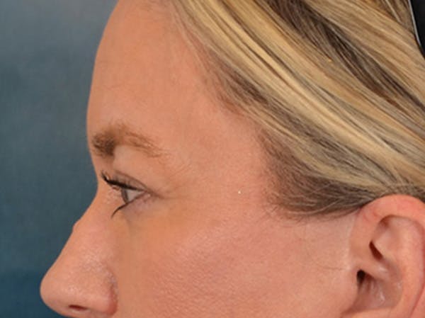 Eyelid Lift Before & After Gallery - Patient 335397 - Image 10