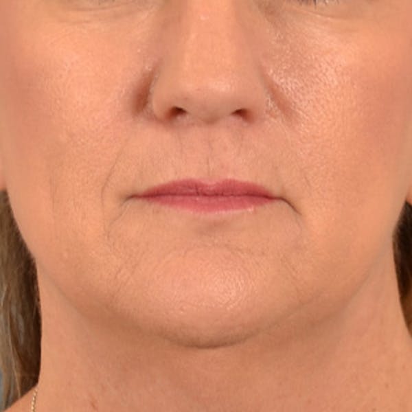 Lip Lift Before & After Gallery - Patient 170757 - Image 1