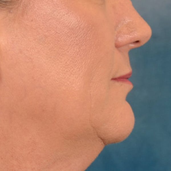 Lip Lift Before & After Gallery - Patient 170757 - Image 5