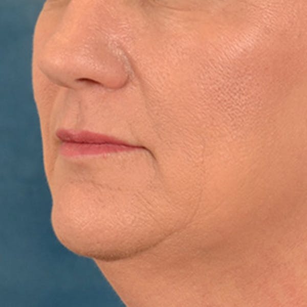 Lip Lift Before & After Gallery - Patient 170757 - Image 7