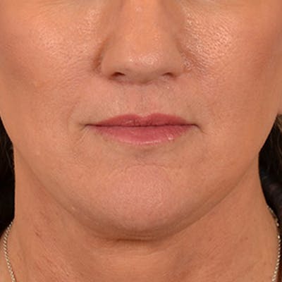 Lip Lift Before & After Gallery - Patient 170757 - Image 2