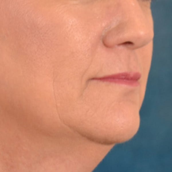 Lip Lift Before & After Gallery - Patient 170757 - Image 3