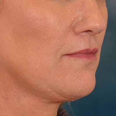 Lip Lift Before & After Gallery - Patient 170757 - Image 4