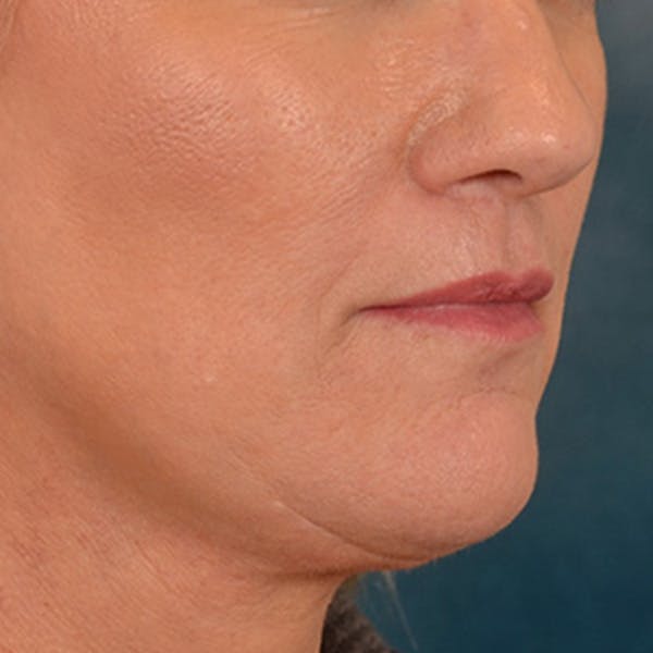 Lip Lift Before & After Gallery - Patient 170757 - Image 4