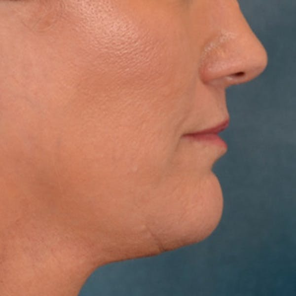 Lip Lift Before & After Gallery - Patient 170757 - Image 6
