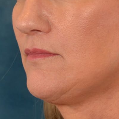 Lip Lift Before & After Gallery - Patient 170757 - Image 8