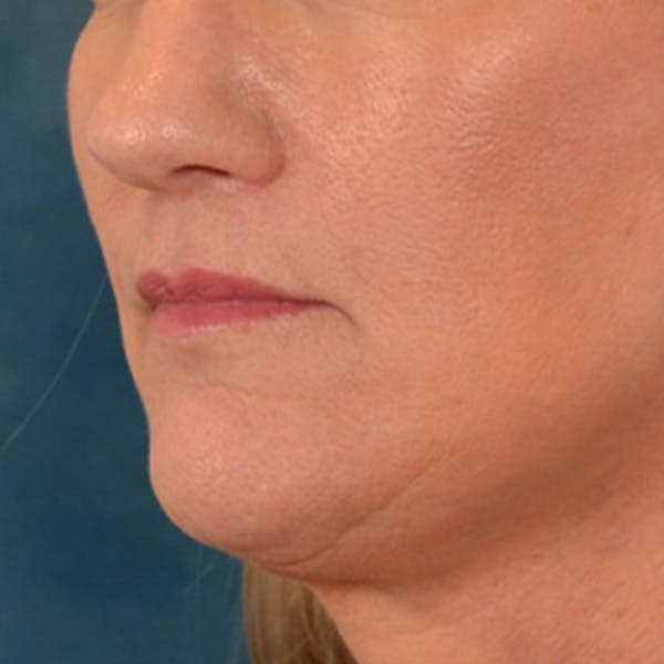 Lip Lift Before & After Gallery - Patient 170757 - Image 8