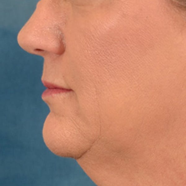 Lip Lift Before & After Gallery - Patient 170757 - Image 9