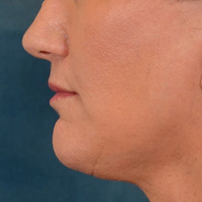 Lip Lift Before & After Gallery - Patient 170757 - Image 10