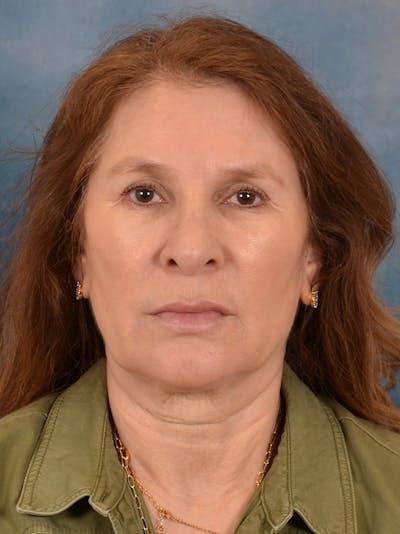 Brow Lift Before & After Gallery - Patient 306629 - Image 1