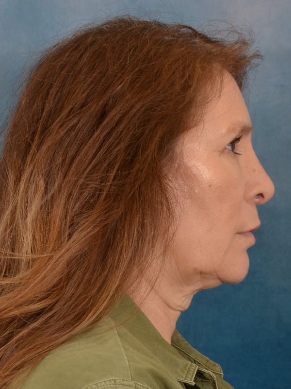 Fat Transfer Before & After Gallery - Patient 707648 - Image 9