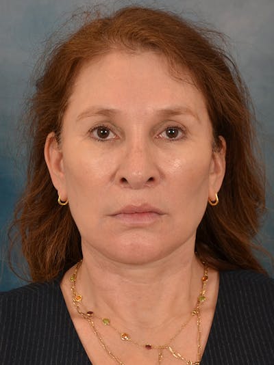 Fat Transfer Before & After Gallery - Patient 707648 - Image 2