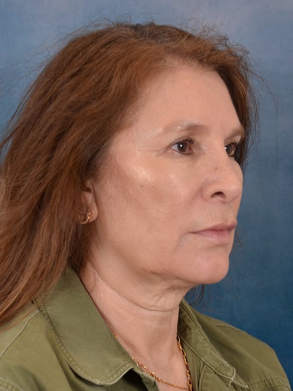 Fat Transfer Before & After Gallery - Patient 707648 - Image 7