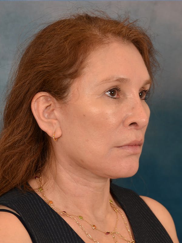 Fat Transfer Before & After Gallery - Patient 707648 - Image 8