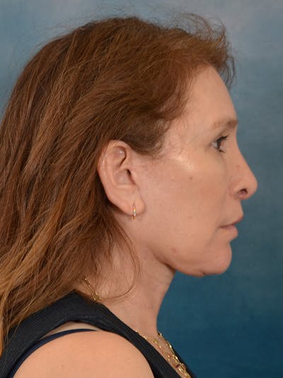 Fat Transfer Before & After Gallery - Patient 707648 - Image 10